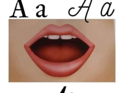 Rối loạn âm lời nói/ nói ngọng.